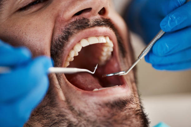 Best Emergency Dentist for Lost Fillings or Crowns in Coronita, CA